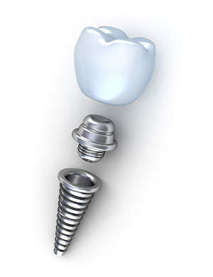 Implante Dentário parcial